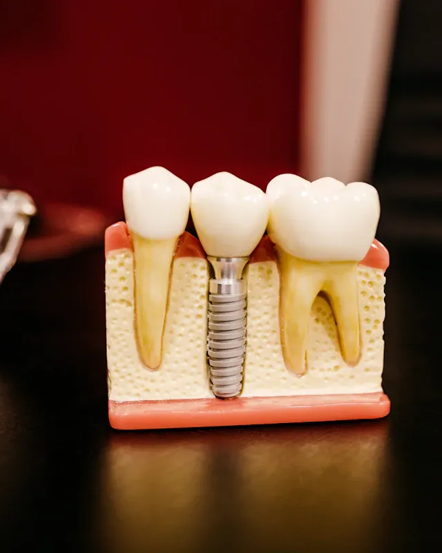 Maqueta de un implante dental de titanio con su corona, junto a dientes naturales